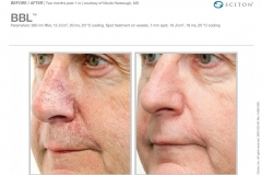 Rosacea